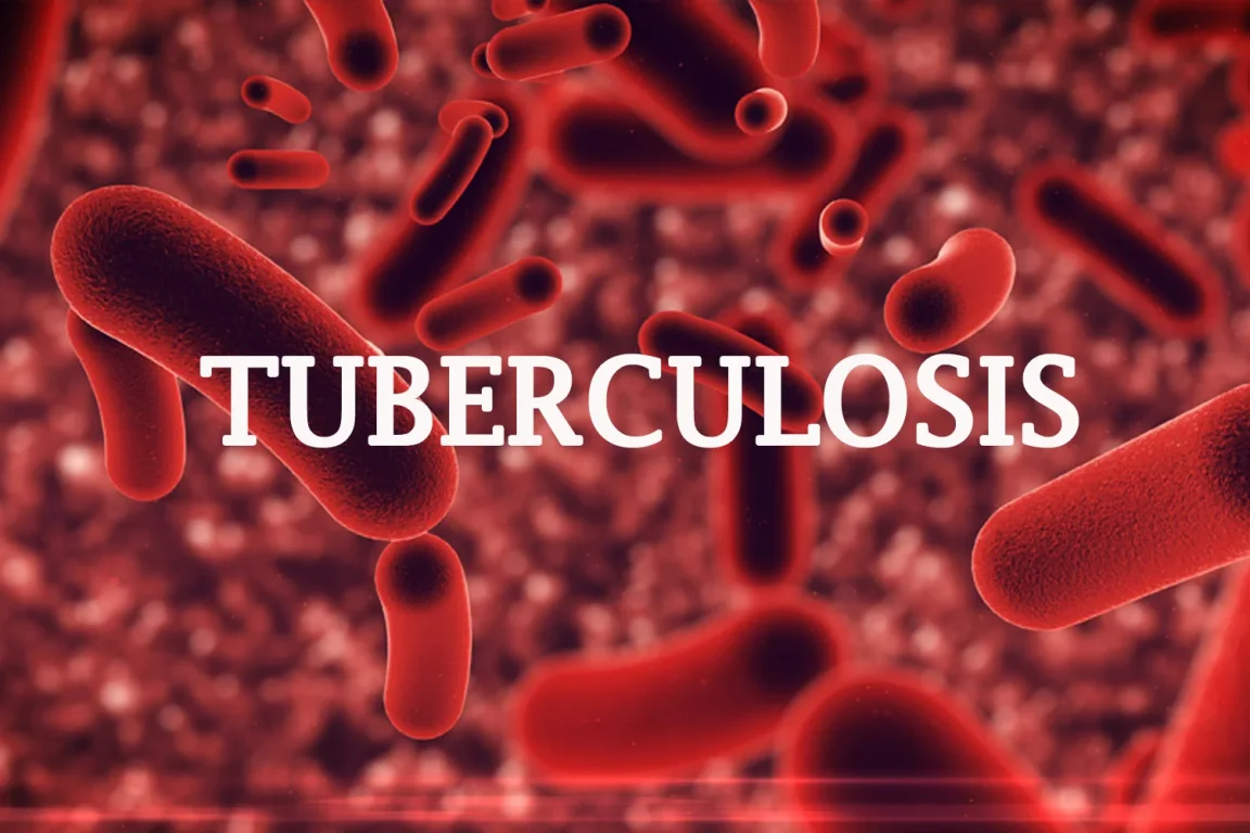 Tuberculosis killed 1,869 in Kwara in 2023 –Commissioner